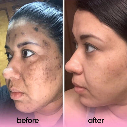 Kojic Acid & Turmeric Cleansing Pads – Buy 1 Get 1 Free